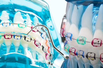 orthodontic model and dentist tool - demonstration teeth model of varities of orthodontic bracket...