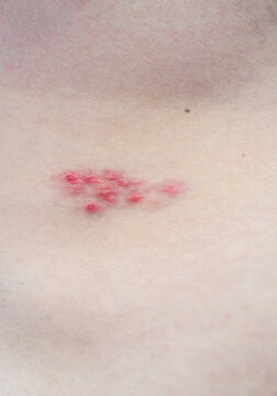 Abdomen of a man with Shingles or Herpes Zoster, a viral disease originate from infection with varicella.