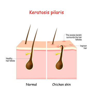 Keratosis Pilaris. Lichen Pilaris And Hair Follicle