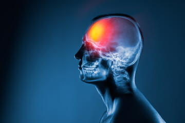 X-ray of a man's head on blue background. Medical examination of head injuries. Cerebral stroke....