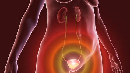 Overactive urinary bladder, 3D illustration - obrazy, fototapety, plakaty