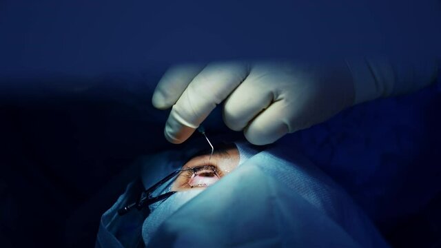 Modern eye healthcare surgery. Cataract professional operating.