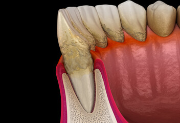 Periodontitis stage 3, gum recession, tartar. Medically accurate 3D illustration