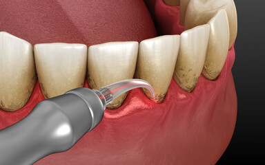 Laser removes tartar and thin layer of infected skin, teeth cleaning. Medically accurate tooth 3D illustration
