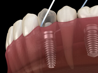 Fototapeta na wymiar Implant tooth cleaning with dental floss. Medically accurate 3D illustration