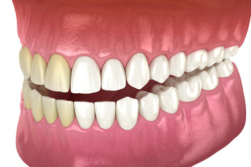 Teeth whitening - before and after. Dental concept, 3D illustration