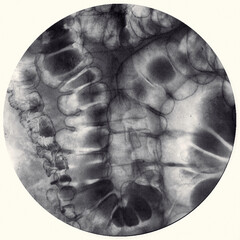 Barium enema image or x-ray image of large intestine or colon showing anatomical of large intestine and appendix for diagnosis Colorectal cancer