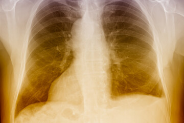 Human chest and lungs. X-ray