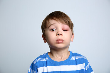 A boy with swollen eye from insect bite. Quincke edema. Portrait of Caucasian appearance child looking at the camera. Studio background. Isolated. Face of allergic person. Copy space. Studio. Allergy - obrazy, fototapety, plakaty