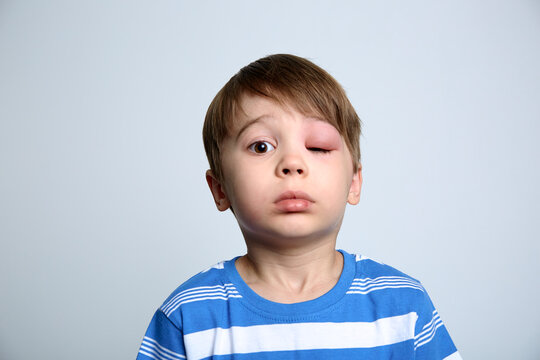 A boy with swollen eye from insect bite. Quincke edema. Portrait of Caucasian appearance child looking at the camera. Studio background. Isolated. Face of allergic person. Copy space. Studio. Allergy