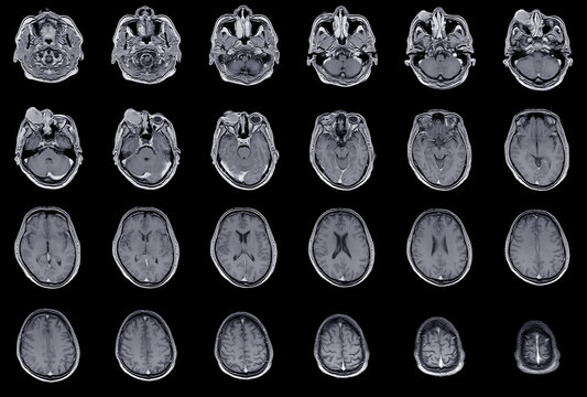 MRI OF BRAIN AND ORBIT HISTORY: Growing right orbital mass for 1 year, Orbital inflammatory disease (orbital pseudotumor)Medical image concept.