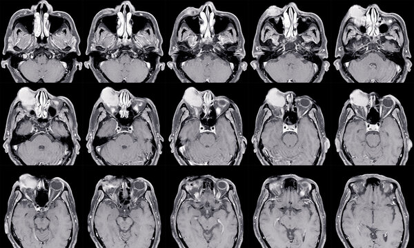 MRI OF BRAIN AND ORBIT HISTORY: Growing right orbital mass for 1 year, Orbital inflammatory disease (orbital pseudotumor)Medical image concept.