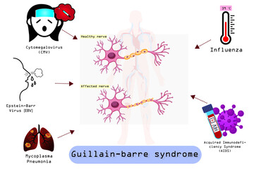 Guillain-Barre (gee-YAH-buh-RAY) syndrome is a rare disorder in which your body's immune system attacks your nerves.