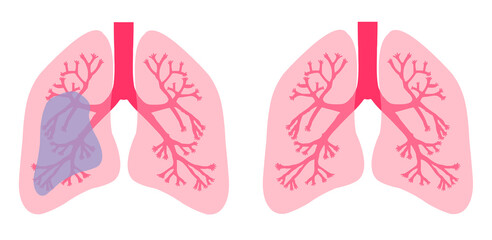 Human lungs are healthy and contaminated. White background. Human lung pneumonia concept.