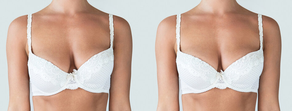 Comparison before and after breast asymmetry correction surgery