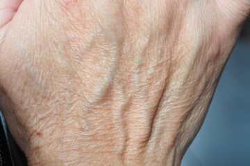 Closeup of human hand with wrinkles in deep layer skin and veins Skin repair and treatment for elderly and aged people