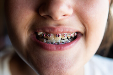 braces on crooked children's teeth