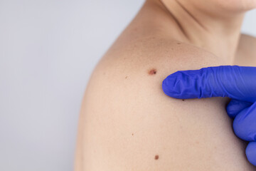 A man at a dermatologist appointment shows his birthmarks, moles and nevi. The doctor examines the...