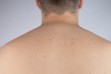 A man at a dermatologist appointment shows his birthmarks, moles and nevi. The doctor examines the...