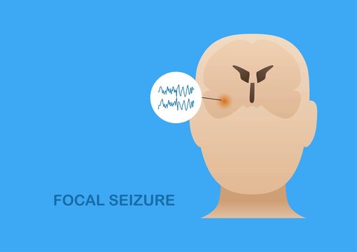 Focal Seizure From Temporal Lobe
