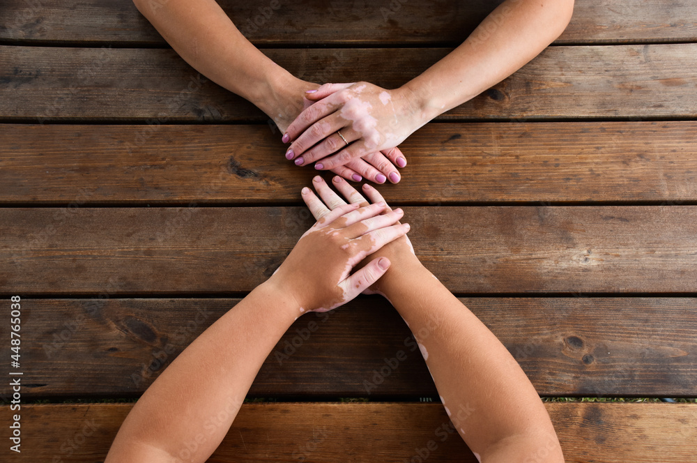 Wall mural Two people (mom and daughter) holding hands together against each other, both affected by vitiligo, autoimmune skin condition with depigmentation. 