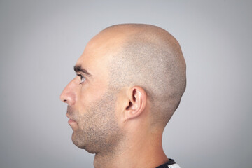 Caucasian bald man in office. Hair loss concept