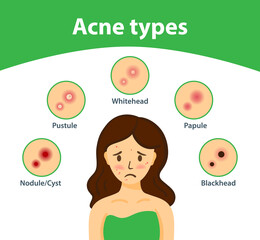 Types of acne, causes of the disease, treatment. Infographics of acne.