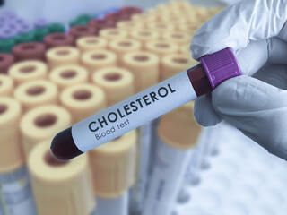 Cholesterol blood test
