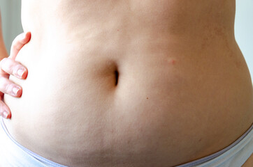 closeup on woman belly, overweight adiposity, fat, real body