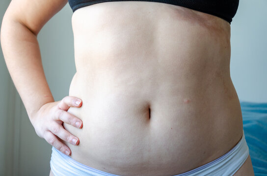 Closeup On Woman Belly, Overweight Adiposity, Fat, Real Body