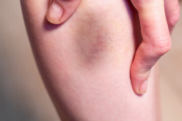 Fototapeta premium Bruise on the leg of a young girl.
