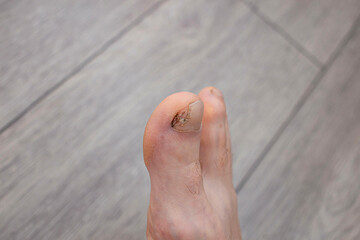 applying an antifungal agent to the toenail of the affected by the fungus close-up, the foreground...