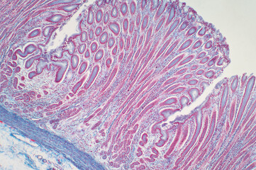 Colon biopsy from the colonoscopy.