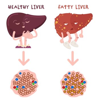 Healthy and fatty liver difference. FLD. Hepatic steatosis.