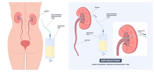 Tube Stent bag blocked kidney stone tumor urine urinary Drain renal ileal conduit stoma foley bladder pelvis Obstructive ureter shock wave ESWL pain cystitis remove surgery pee Cancer tract transplant