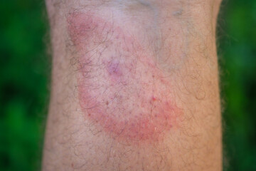 migrating erythema after a tick bite on a man's leg. a symptom of tick-borne borreliosis. a red...