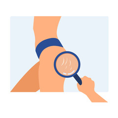 
Female body with stretchmarks on hips and hand with magnifying glass. Striae on woman legs. Body positivity, beauty, skincare concepts