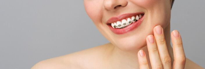 Orthodontic treatment. Closeup ceramic and metal brackets on teeth. Female smile with braces....