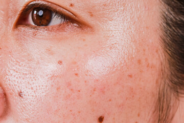 Skin care problems and health concepts Wrinkles, pores, freckles, dark spots, dry skin on the face