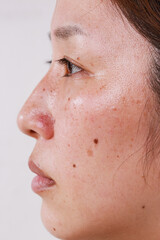 Close-up of a woman's face, half face, portrait with large pores black dots care for problem skin