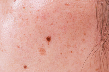 Fototapeta premium Problems with oily skin with freckles and dark spots