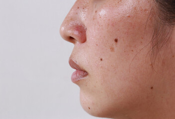 Facial skin problems for women and health problems Dark spots with freckles and blemishes