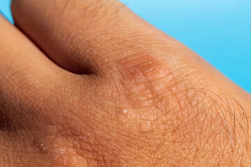 Extremely dry, dehydrated and cracked skin of a man hand with fragments of epidermis. Close-up selective focus
