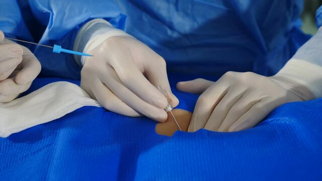 Vascular surgery. Radiologist performs endovascular operation with angiography machine. Doctor using contrast liquid for uterine fibroid embolization. Cardio-vascular examination. 4k video