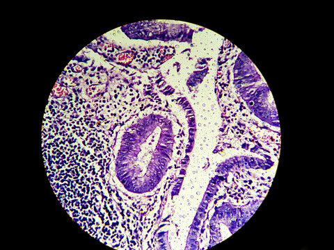 Microscopic Image (photomicrograph) Of A Sessile Serrated Adenoma Of Colon. Similar To Tubular And Villous Adenomas, These Precancerous Polyps Are Removed By Colonoscopy To Prevent Cancer.