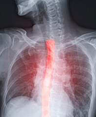 Esophagram or Barium swallow  image   showing Esophageal stent placement for patient  Esophageal cancer.