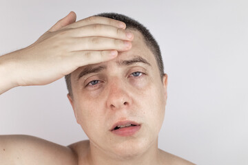 Obraz premium A man with sweating on his face is looking at the camera. Sweat gland problems. Hyperhidrosis, increased sweating, anhidrosis. The concept of treatment for violations of the mechanisms of secretion.