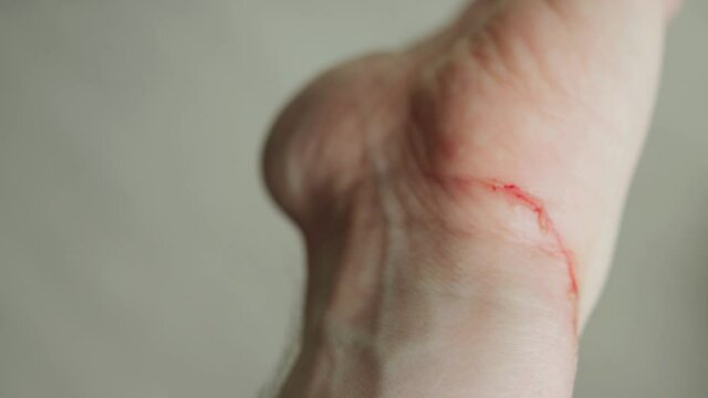 Wound cut on a man's hand, close-up. Blood on the wrist, skin