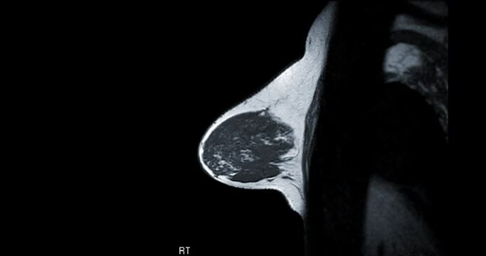 Breast MRI or magnetic resonance imaging sagittal T1W of Breast in women for screening breast cancer. 