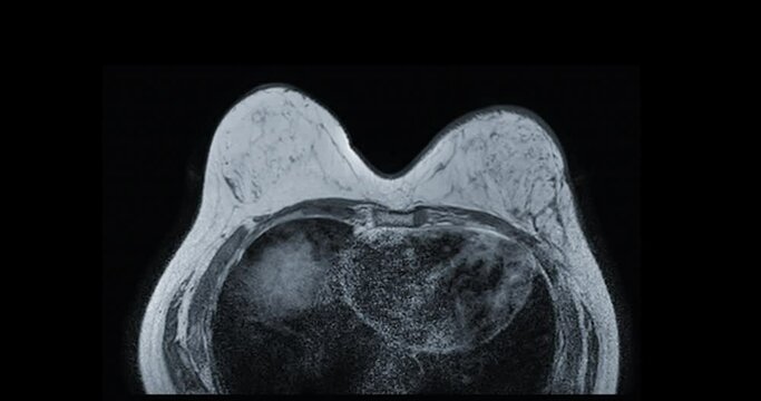 Breast MRI or magnetic resonance imaging axial T1W of Breast in women for screening breast cancer. 